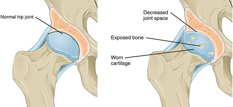 Primary Hip Replacement