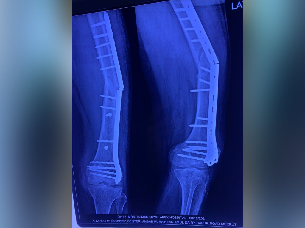 suman Complex trauma post surgery