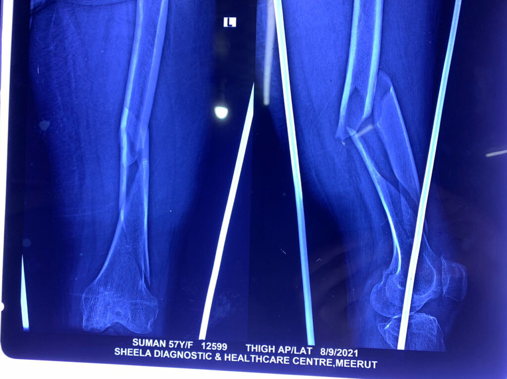 suman Complex trauma pre surgery